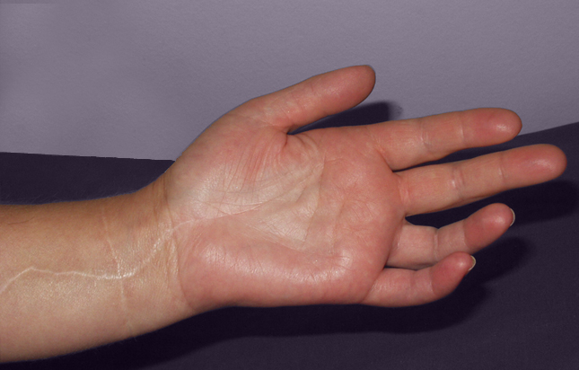 After the reconstruction of the median nerve